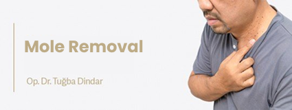 Mole Removal